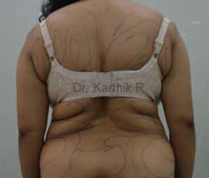 Liposuction Tummy and Back