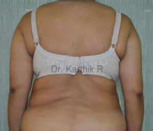 Liposuction Tummy and Back