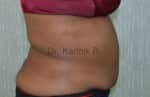 Liposuction Tummy and Back