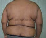 Liposuction Tummy and Back