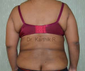 Liposuction Tummy and Back