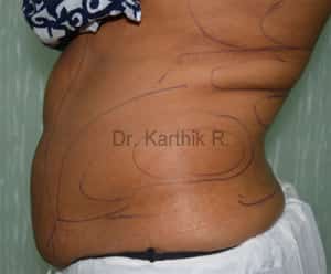 Liposuction Tummy and Back