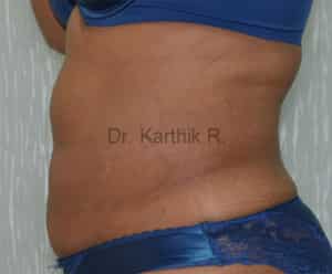 Liposuction Tummy and Back