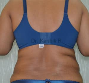 Liposuction Tummy and Back