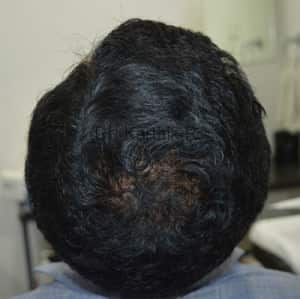 Dermaroller scalp