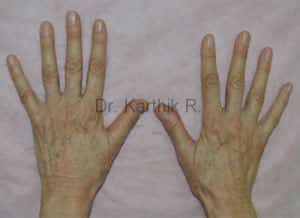 Fat Graft / Fat Fill/ Fat Transfer