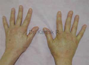 Fat Graft / Fat Fill/ Fat Transfer