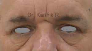 Blepharoplasty