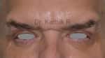 Blepharoplasty