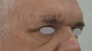 Blepharoplasty