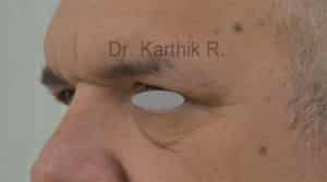 Blepharoplasty