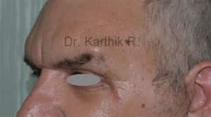 Blepharoplasty