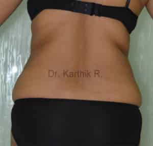 Liposuction Tummy and Back