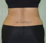 Liposuction Tummy and Back