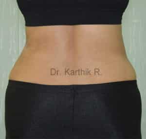 Liposuction Tummy and Back