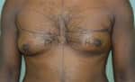 Gynecomastia (Puffy Nipples/ Male Chest Correction)