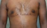 Gynecomastia (Puffy Nipples/ Male Chest Correction)