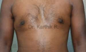 Gynecomastia (Puffy Nipples/ Male Chest Correction)