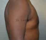 Gynecomastia (Puffy Nipples/ Male Chest Correction)