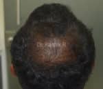 Dermaroller scalp