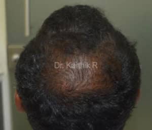 Dermaroller scalp