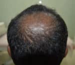 Dermaroller scalp