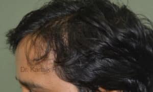 Hair Transplantation
