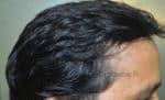 Hair Transplantation