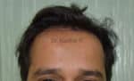 Hair Transplantation