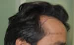 Hair Transplantation