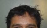 Hair Transplantation