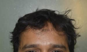 Hair Transplantation