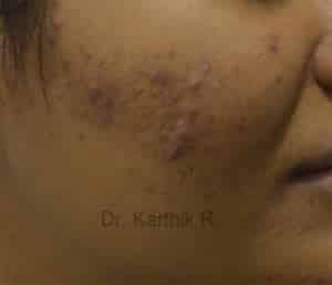 Chemical Peels & Microdermabrasion