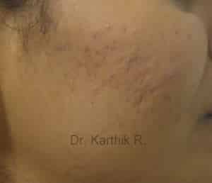 Chemical Peels & Microdermabrasion