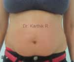 Exilis