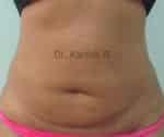 Exilis