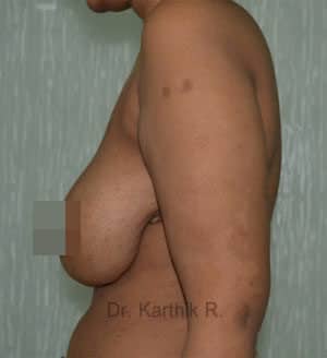 Breast Reduction and Breast Lift