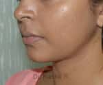 Double Chin Liposuction