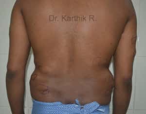 Multiple Lipoma