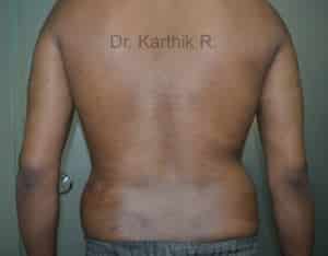 Multiple Lipoma