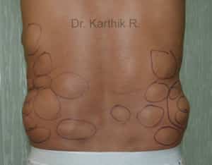 Multiple Lipoma