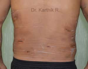 Multiple Lipoma