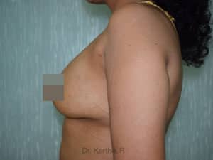 Breast Fat Fill (Breast Augmentation)
