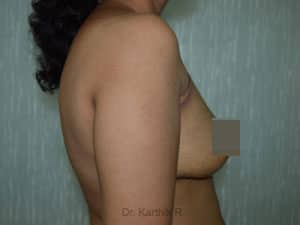 Breast Fat Fill (Breast Augmentation)