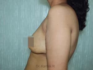 Breast Fat Fill (Breast Augmentation)