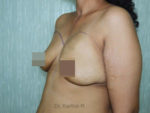 Breast Fat Fill (Breast Augmentation)