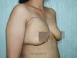 Breast Fat Fill (Breast Augmentation)