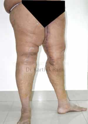 Thigh Lift