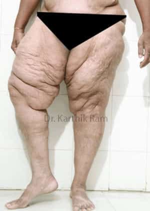 Thigh Lift