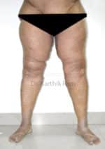 Thigh Lift